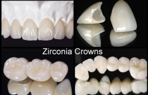 Zirconia Crowns