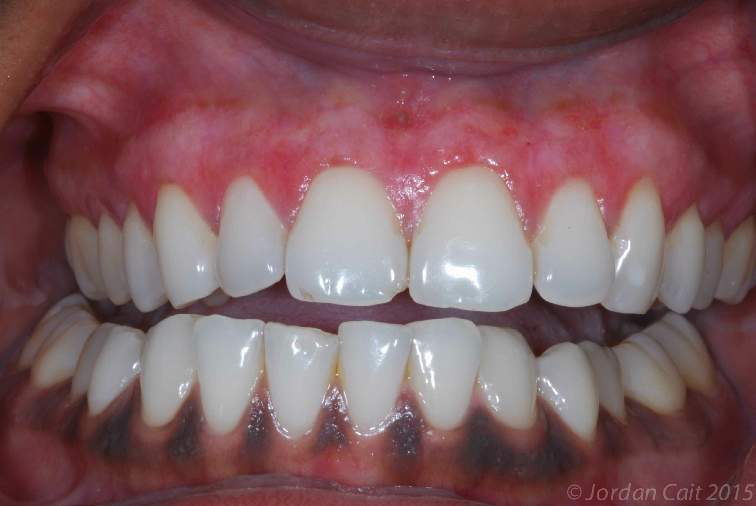 Gum Depigmentation