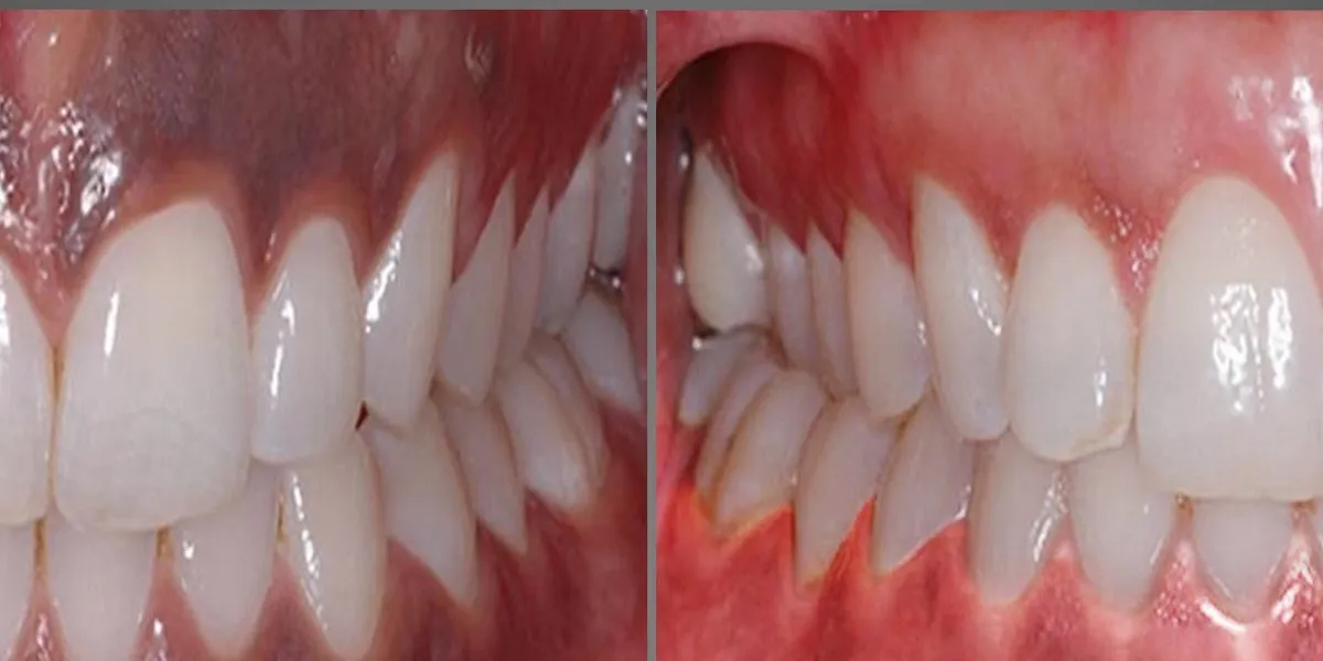 gum pigmentation