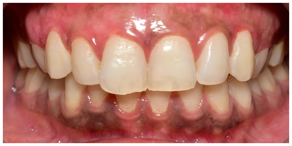 Gum Depigmentation/Gum Bleaching