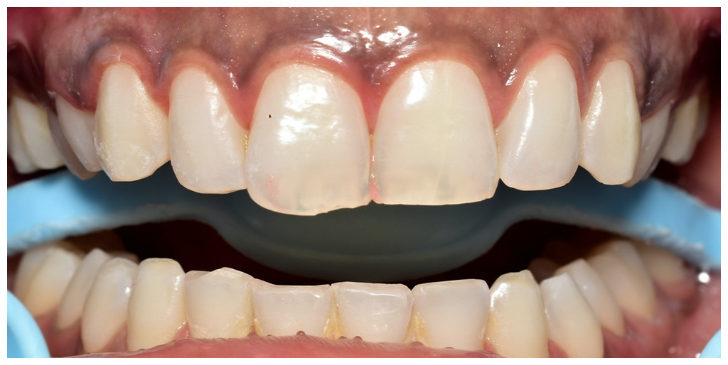 Gum Depigmentation/Gum Bleaching