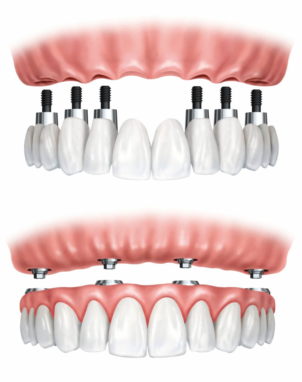 Implant Dentures