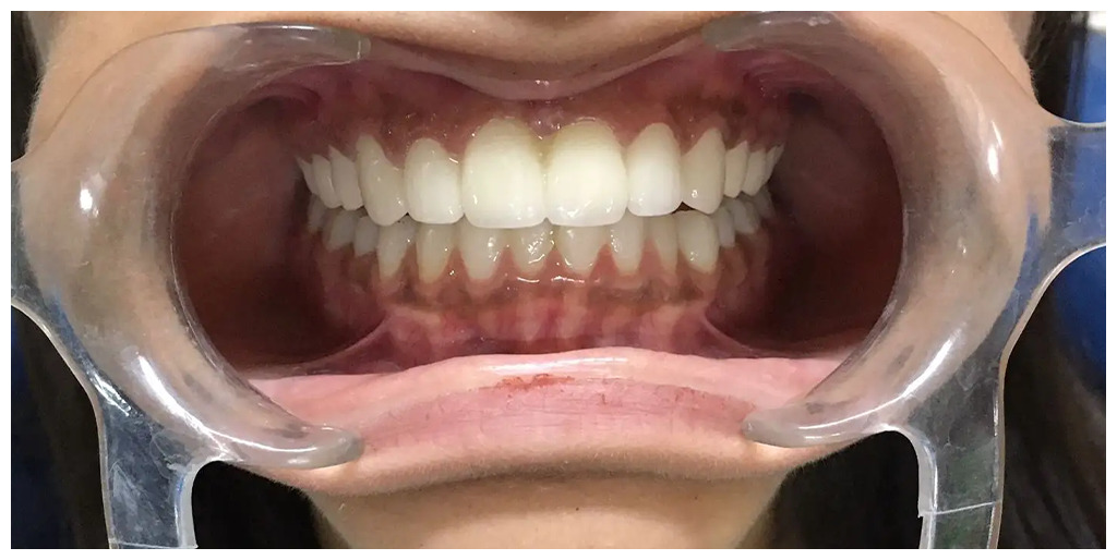 Gummy smile treatment