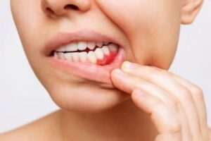 Gum Disease Women