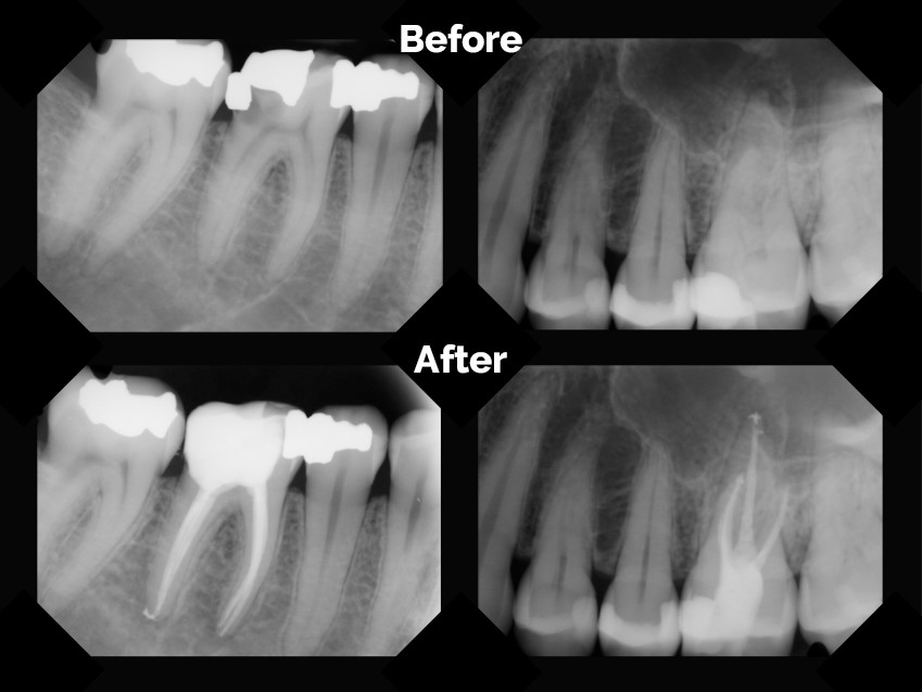 root canal before after