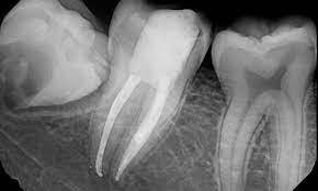 Root Canal Treatment