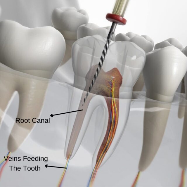 Root Canal