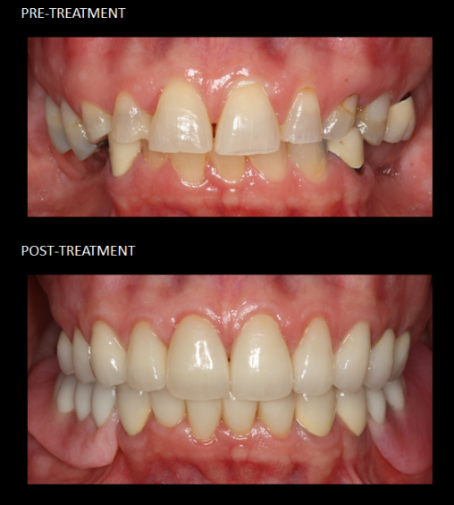 Process Dental Veneers