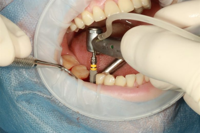 What Are Dental Implants Made Of