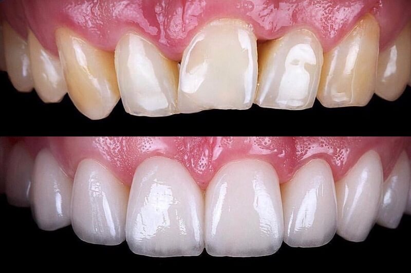 Dental Veneers Nyc Before After