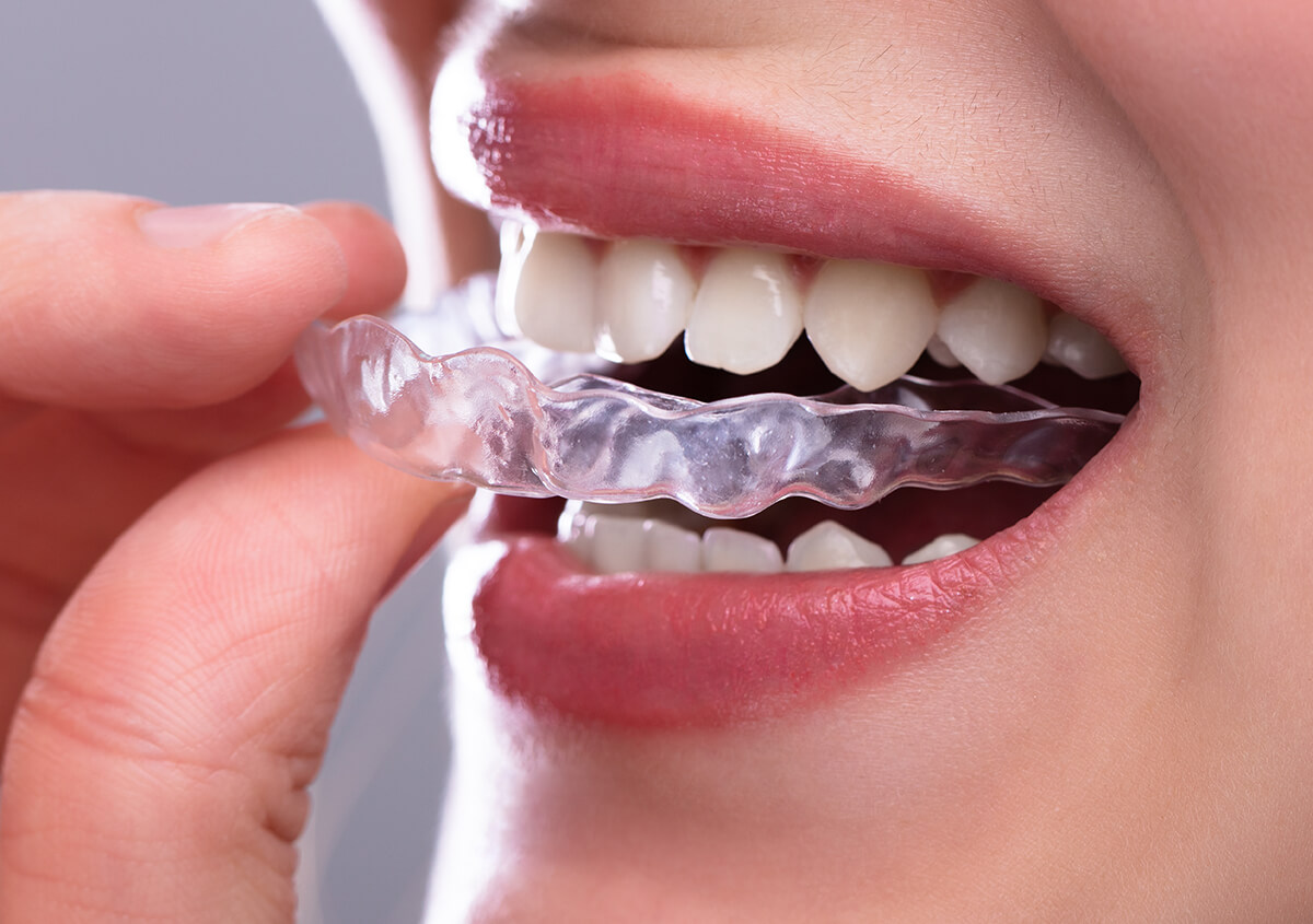 Invisalign