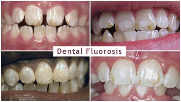 Dental Fluorosis