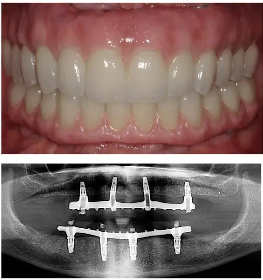 All On 4 Dental Implants Houston