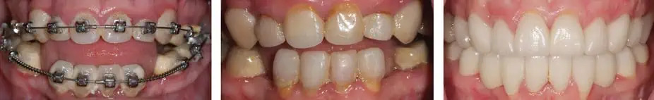 Denta Crowns Before After