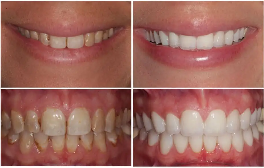 Fluorosis Treatment With Complete Ceramic Crowns