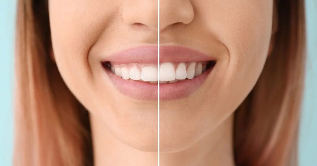 How gum contouring enhances a smile makeover?