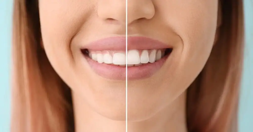 Transform Your Smile Makeover with Gum Contouring
