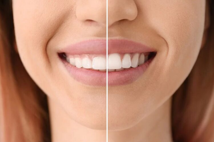 How gum contouring enhances a smile makeover?