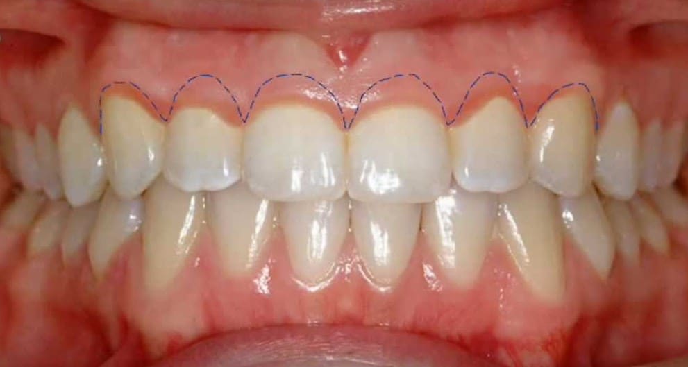 Gingivectomy Illustration For Gummy Smile Featured Image