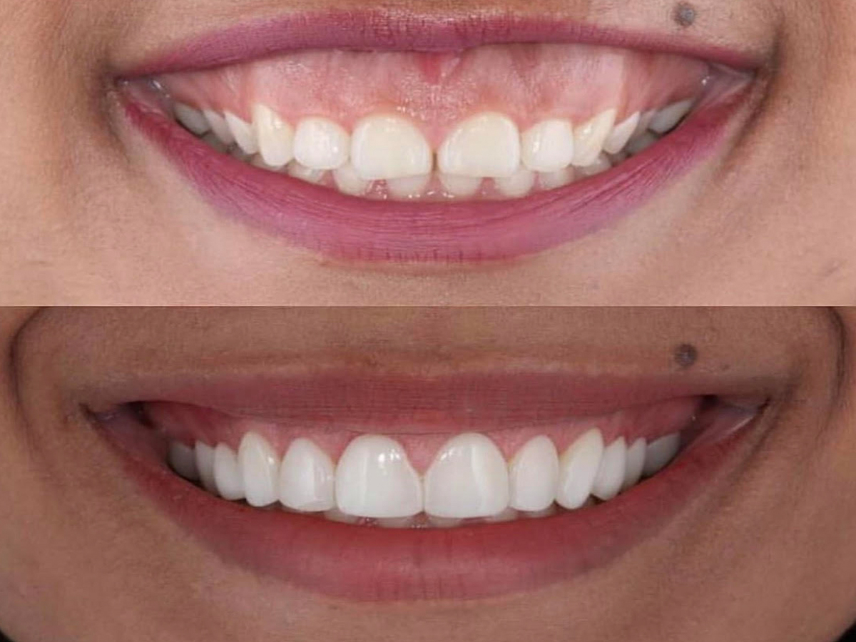 Gummy Smile Correction Gum Countrin