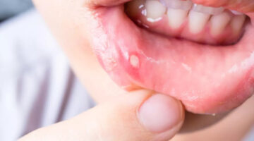 What Are Mouth Ulcers?