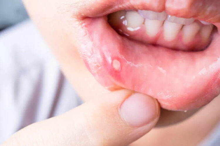 What Are Mouth Ulcers?