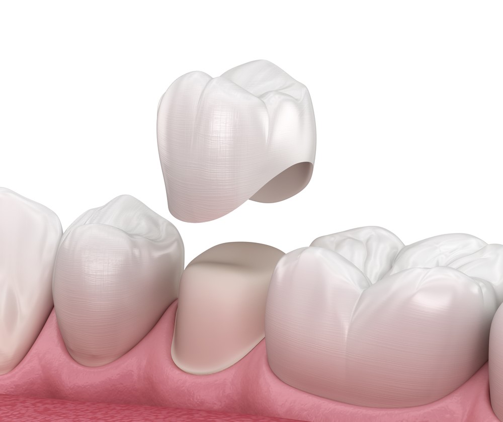 Benefits Of Dental Crowns