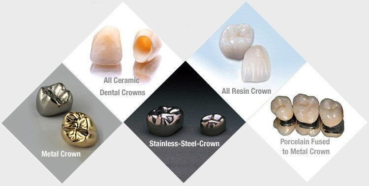 Different Types Of Dental Crowns