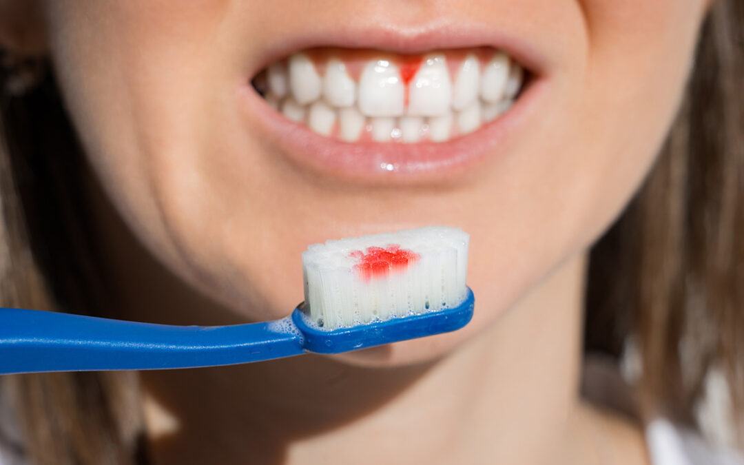 Close Up Of Woman Mouth With Bleeding Gums