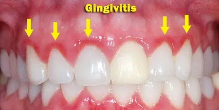 Gingivitis.