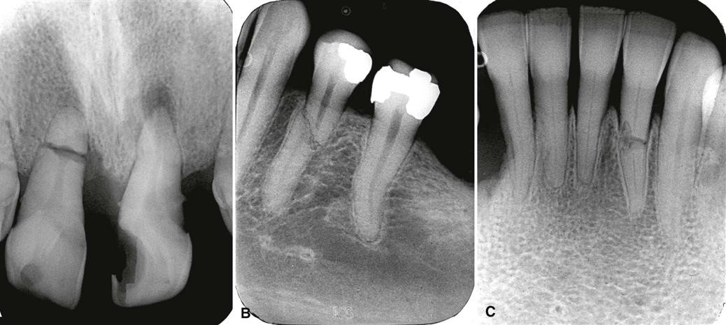 Dental X-Rays