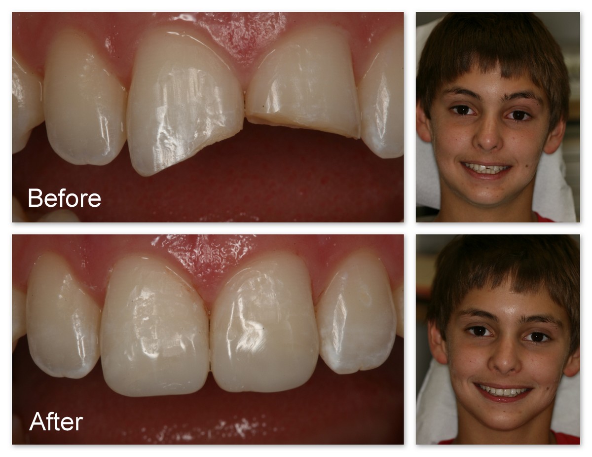 15 Fractured Teeth, Composite Resin