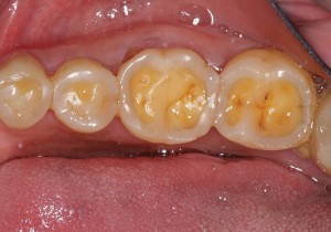 Chemical Erosion Of Teeth