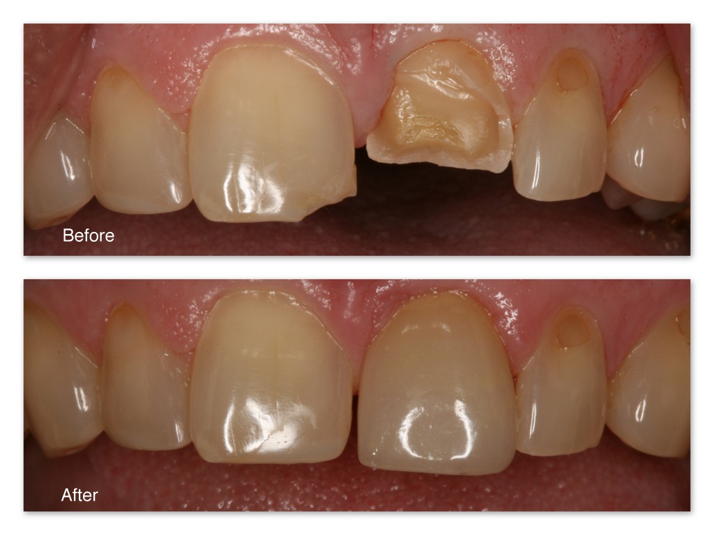 Treatment Options for Fractured Tooth