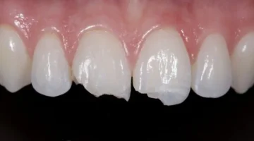 Tooth Fractures