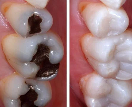 White Fillings Versus Silver Amalgam Fillings