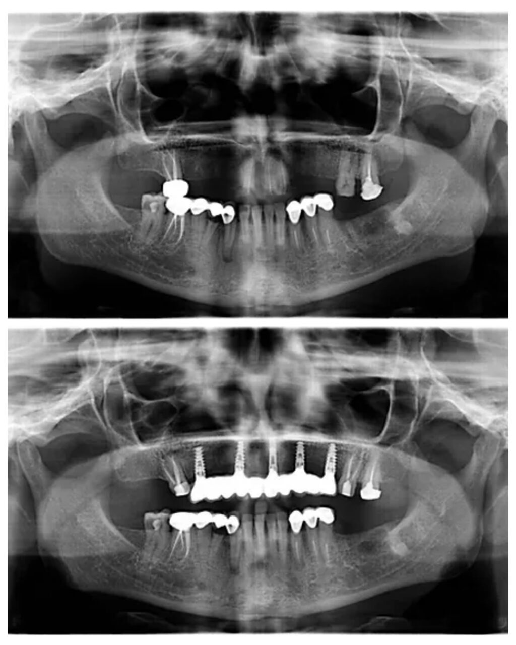 Full Mouth Rehabilitation