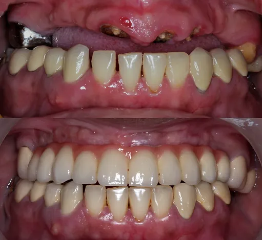 Full Mouth Rehabilitation