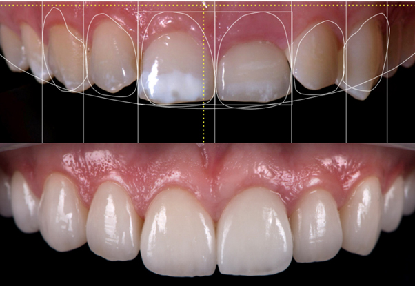 Full Mouth Rehabilitation