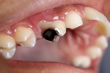 Best Treatment Options Available For Tooth Decay