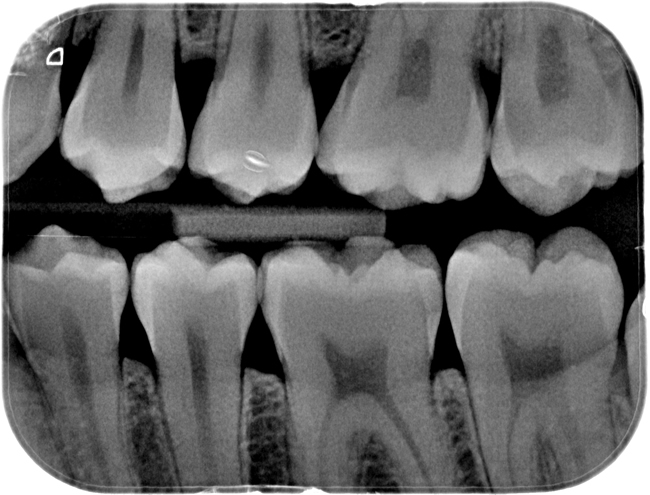 Rvg X Rays Post Img