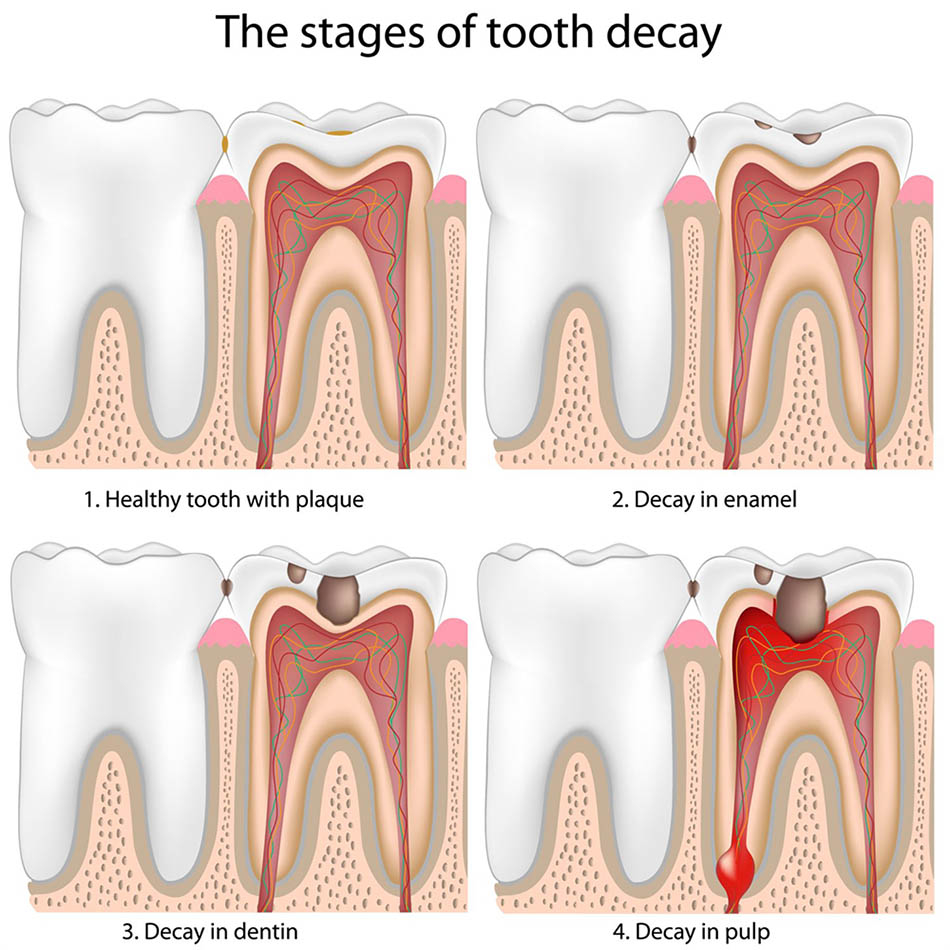 Best Treatment Options Available For Tooth Decay