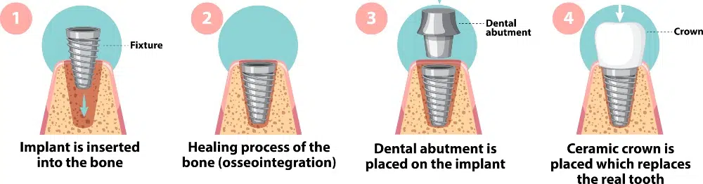 Dental Implants Stages