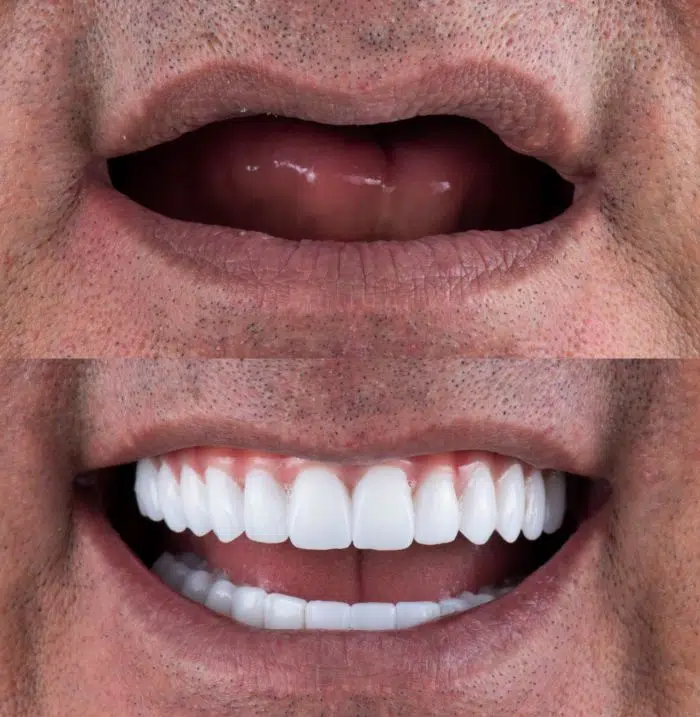 Full Mouth Restoration Before And After