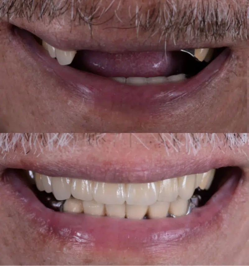 Implant Supported Bridge Before And After