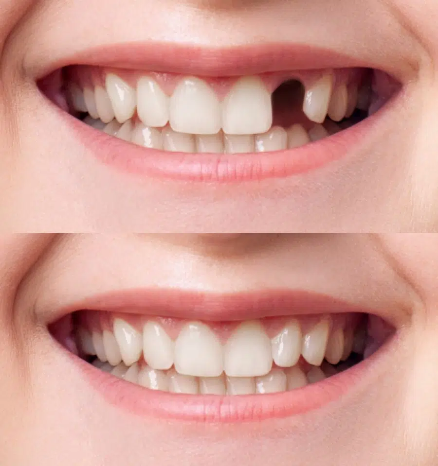 Single Dental Implants Before And After