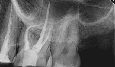 Root Canal