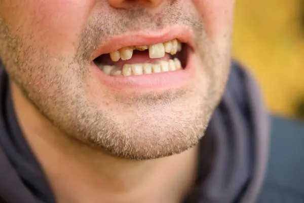 Tooth Loss Impact On Quality Of Life