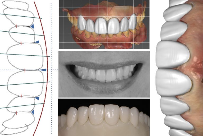 All Ceramic Veneers