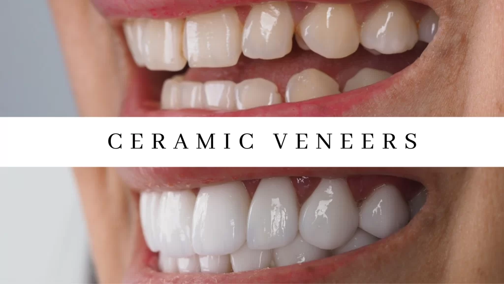 Ceramic Veneers